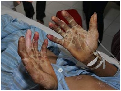 Bệnh nhân hoại tử chân tay do nhiễm khuẩn liên cầu lợn