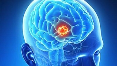 Phương pháp mới điều trị u não tiết kiệm hơn 90% chi phí