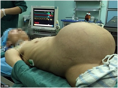 Trung Quốc: Phẫu thuật thành công khối u nặng 15kg cho bệnh nhân