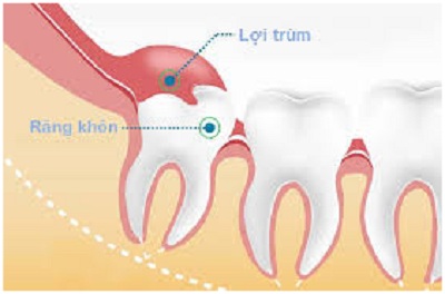 Nhiễm trùng răng khôn có thể dẫn đến tử vong