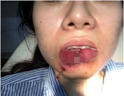 Thiếu nữ phải cắt bỏ môi sau khi tiêm chất làm đầy