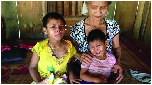 Bệnh lạ khiến trẻ em ở Phú Thọ tử vong là khô da sắc tố