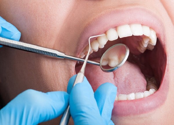 Cách chăm sóc răng chuẩn sau lấy cao răng