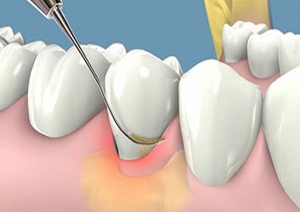 Cách phân biệt cao răng huyết thanh với cao răng nước bọt chuẩn nhất