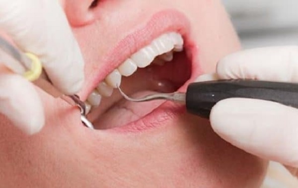 Cao răng huyết thanh gây ảnh hưởng đến sức khỏe răng miệng thế nào?