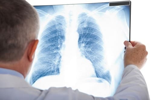 Những ai nên cần đi chụp X-quang phổi sau khi khỏi Covid-19