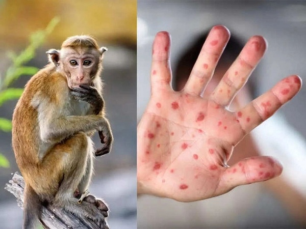 Những đối tượng nào có nguy cơ cao mắc bệnh đậu mùa khỉ