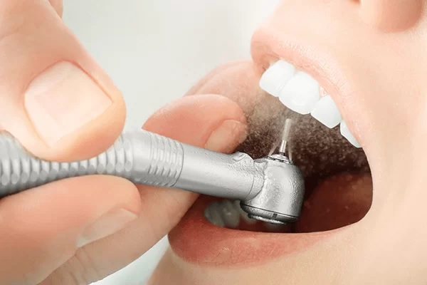Quy trình lấy cao răng chuẩn được thực hiện như thế nào?