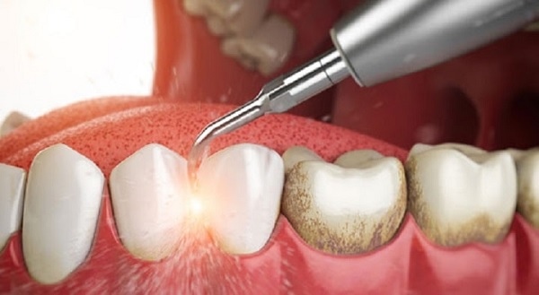 Sau lấy cao răng cần kiêng điều gì?
