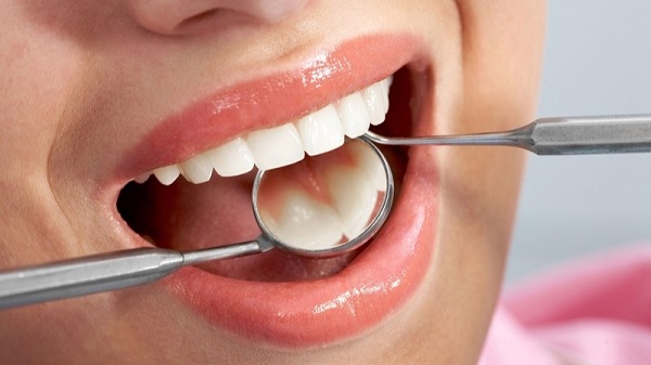 Top 7 cách hay nhất giúp ngăn ngừa cao răng hiệu quả