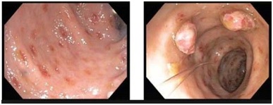 Nhiễm giun lươn Bệnh nguy hiểm chớ nên coi thường