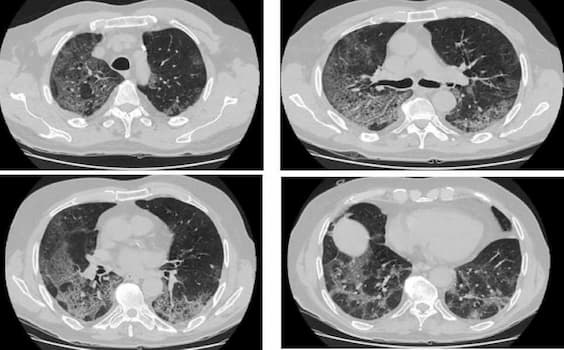Sau khi khỏi COVID-19: Phục hồi tình trạng sức khỏe người bệnh như thế nào?