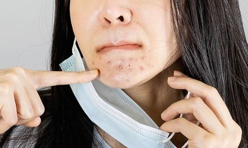 Bật mí cách xử lý làn da nổi mụn do đeo khẩu trang
