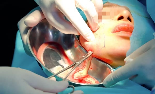 Cẩn trọng hoại tử cằm khi tiêm filler cằm